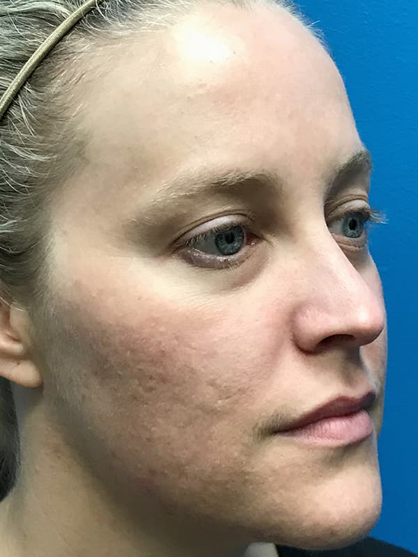 Broadband Light After - Patient 93894460 - Front View