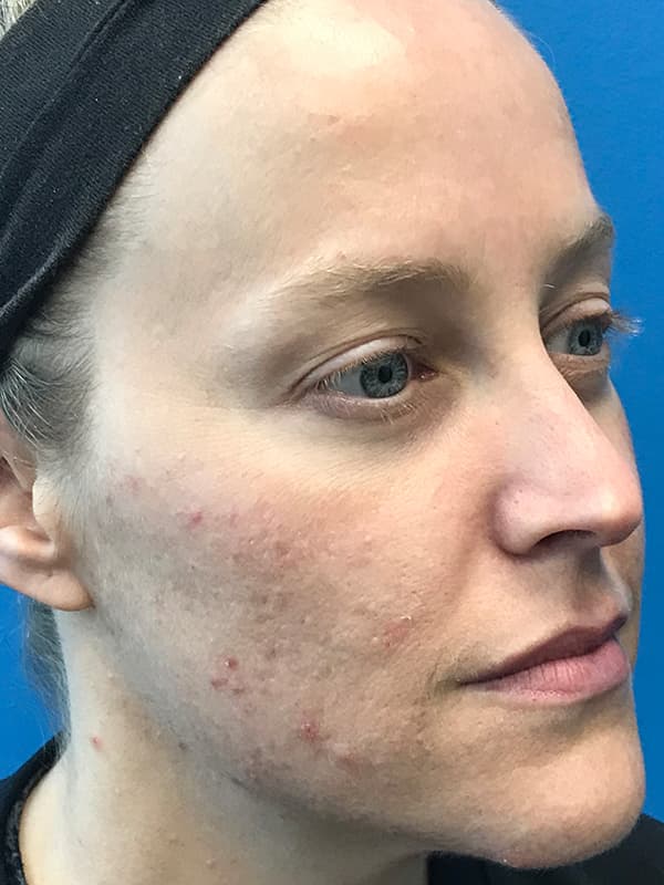 Broadband Light Before - Patient 93894460 - Front View