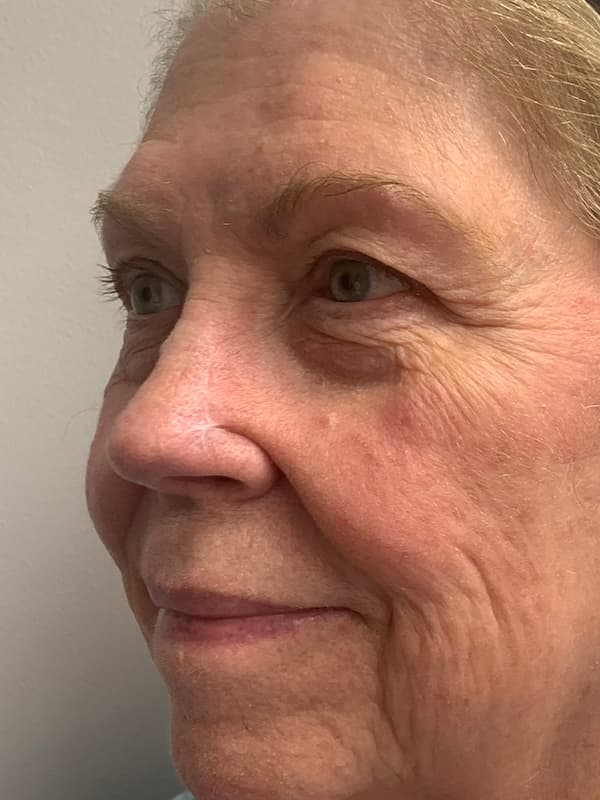 Broadband Light After - Patient 93894512 - Front Left View