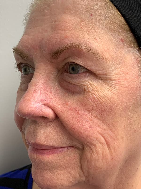 Broadband Light Before - Patient 93894512 - Front Left View