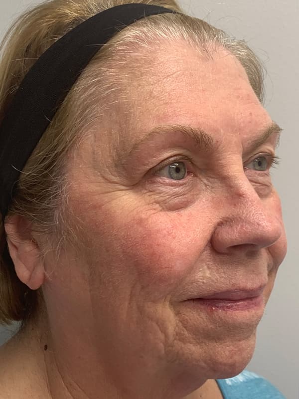 Broadband Light After - Patient 93894512 - Front View