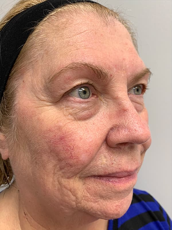 Broadband Light Before - Patient 93894512 - Front View