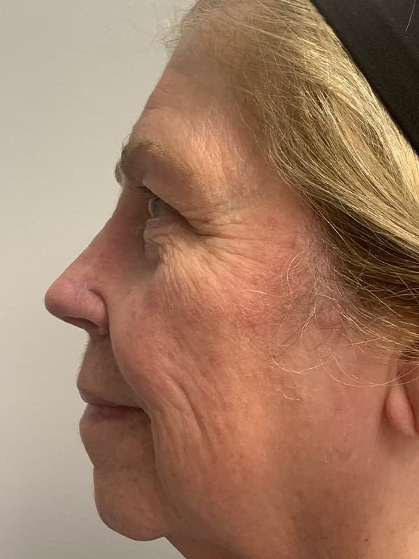 Broadband Light After - Patient 93894512 - Left View