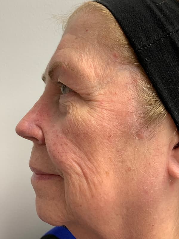 Broadband Light Before - Patient 93894512 - Left View