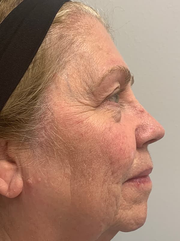 Broadband Light After - Patient 93894512 - Right View