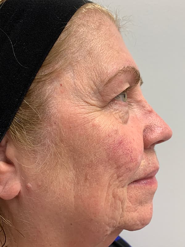 Broadband Light Before - Patient 93894512 - Right View