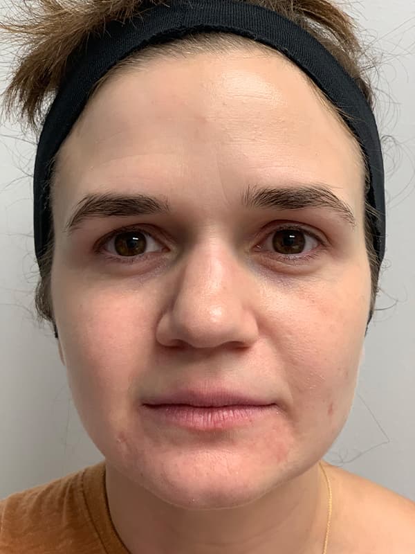 Broadband Light After - Patient 93894529 - Front View