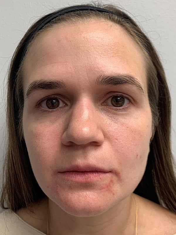 Broadband Light Before - Patient 93894529 - Front View