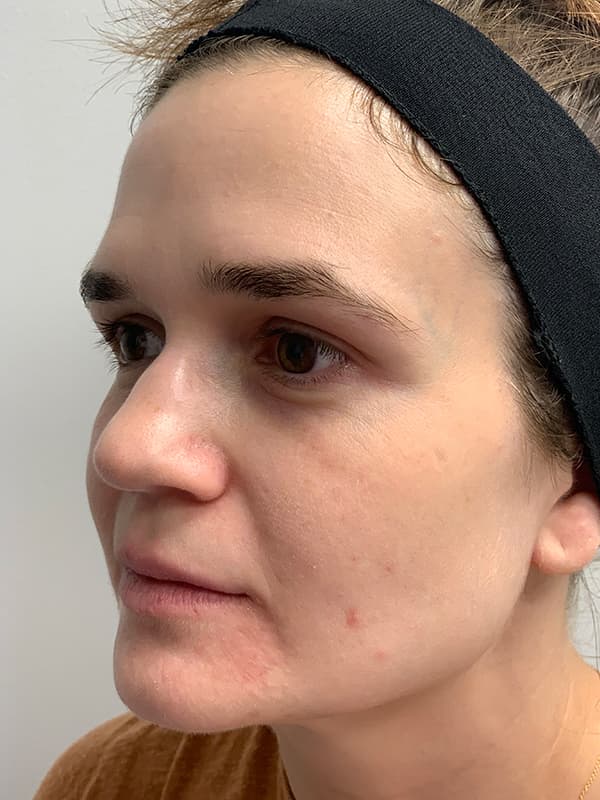 Broadband Light After - Patient 93894529 - Front Left View