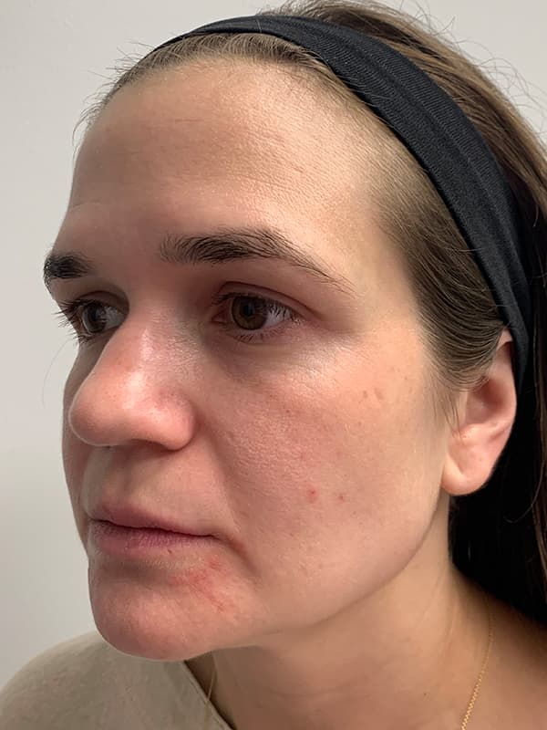 Broadband Light Before - Patient 93894529 - Front Left View