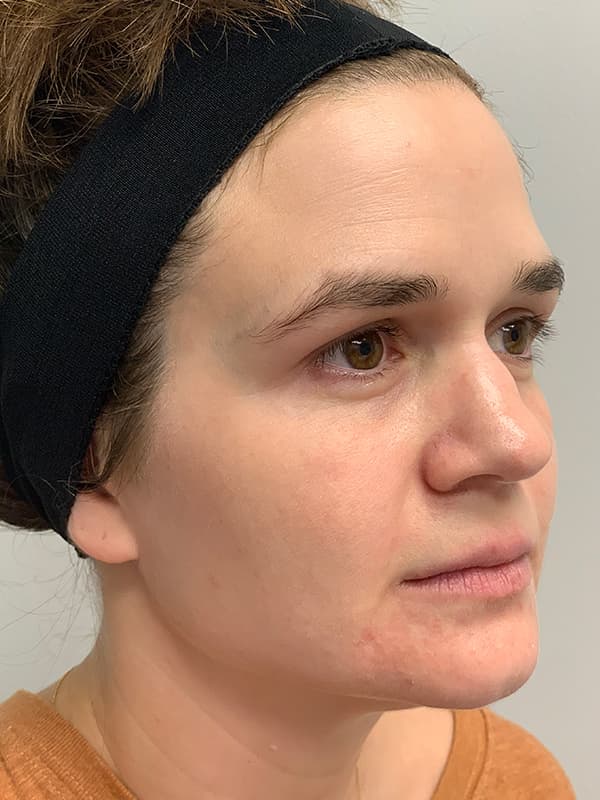 Broadband Light After - Patient 93894529 - Front Right View