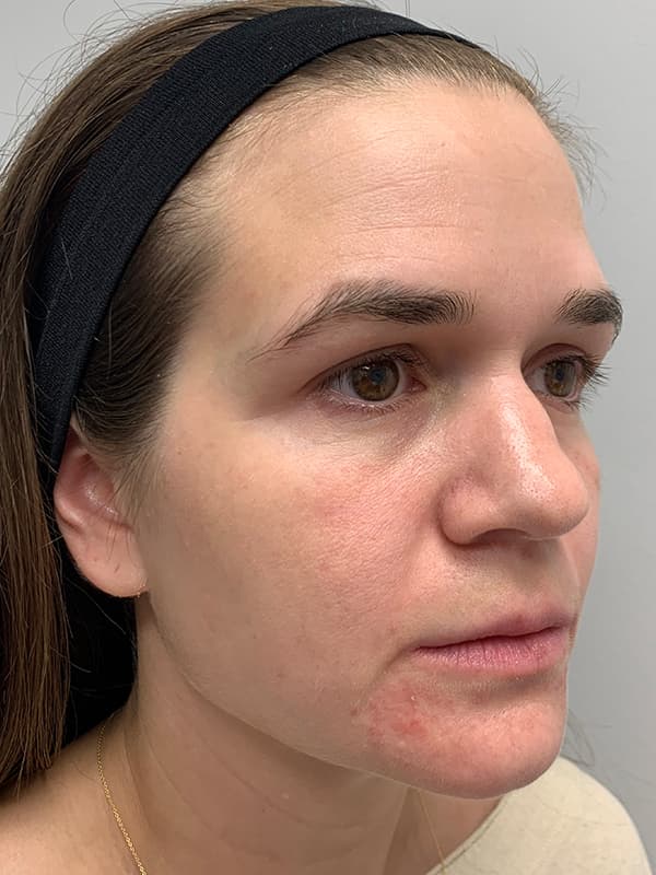 Broadband Light Before - Patient 93894529 - Front Right View