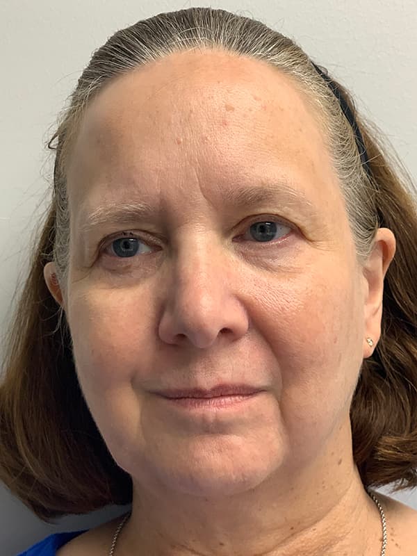 Broadband Light After - Patient 93894554 - Front View