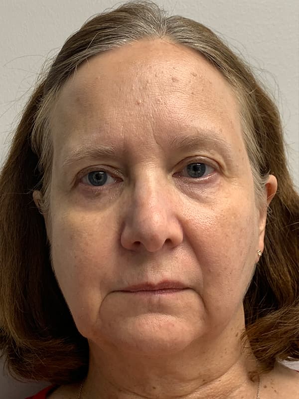 Broadband Light Before - Patient 93894554 - Front View