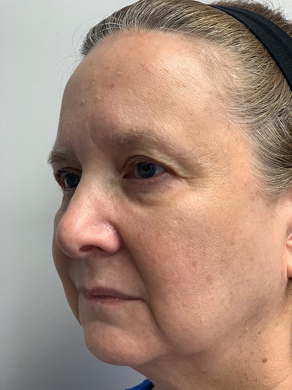 Broadband Light After - Patient 93894554 - Front Left View