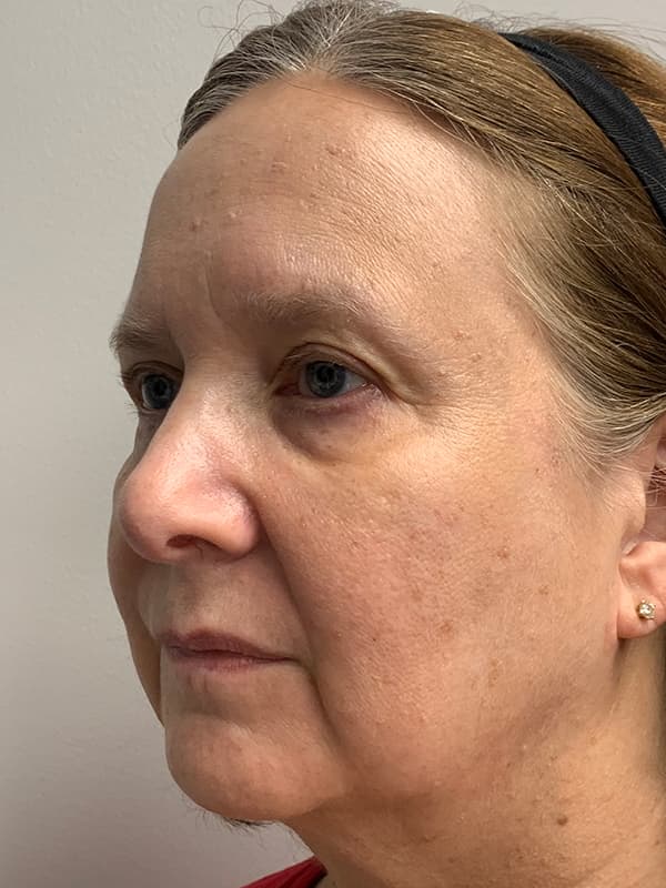 Broadband Light Before - Patient 93894554 - Front Left View