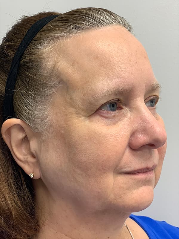 Broadband Light After - Patient 93894554 - Front Right View