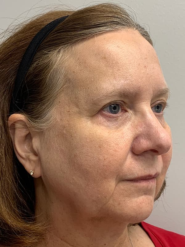 Broadband Light Before - Patient 93894554 - Front Right View