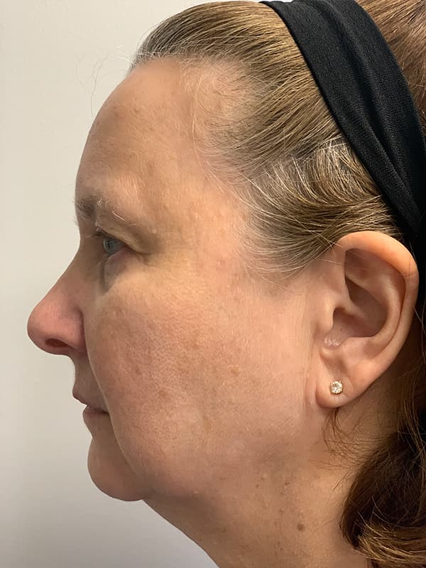 Broadband Light After - Patient 93894554 - Left View