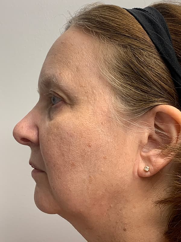 Broadband Light Before - Patient 93894554 - Left View