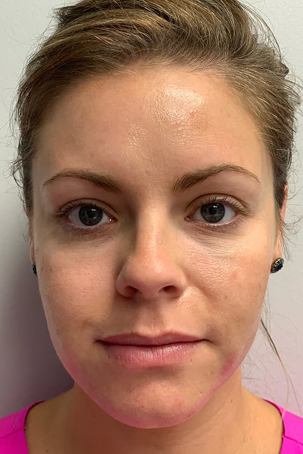 Contour TRL After - Patient 93894479 - Front View