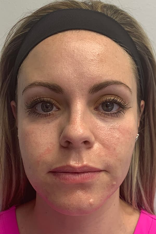 Contour TRL Before - Patient 93894479 - Front View