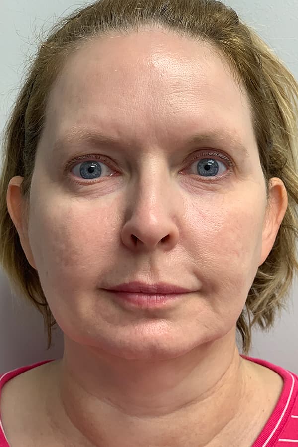 Contour TRL After - Patient 93894534 - Front View
