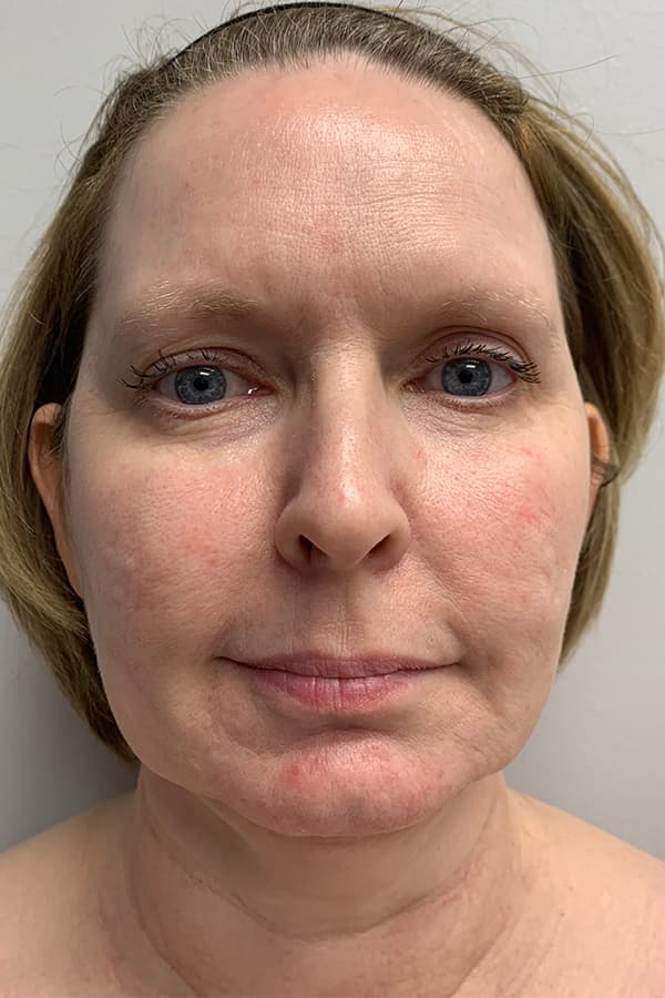 Contour TRL Before - Patient 93894534 - Front View