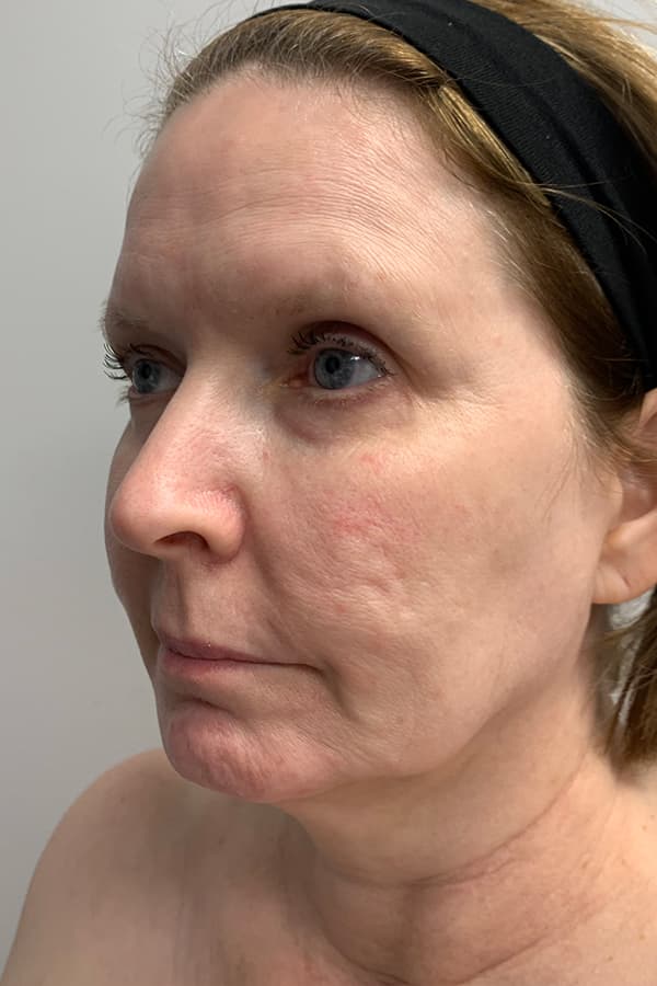 Contour TRL Before - Patient 93894534 - Front Left View
