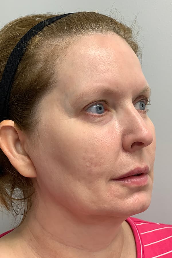 Contour TRL After - Patient 93894534 - Front Right View