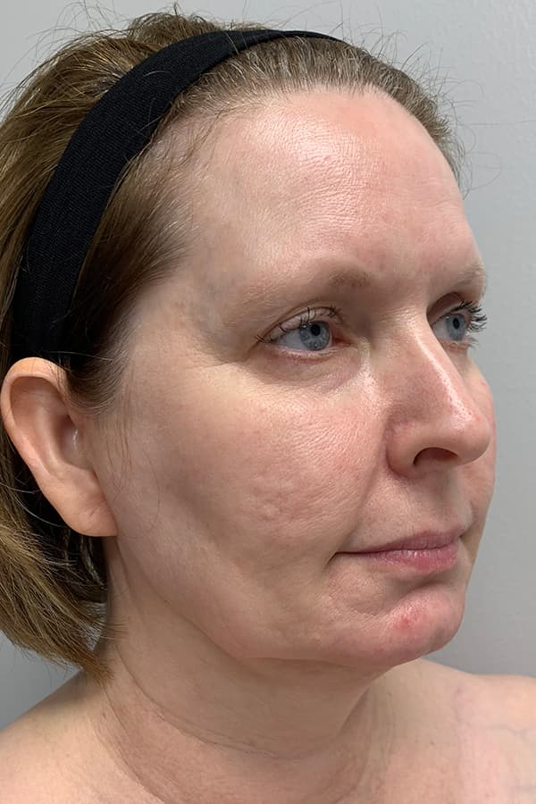 Contour TRL Before - Patient 93894534 - Front Right View