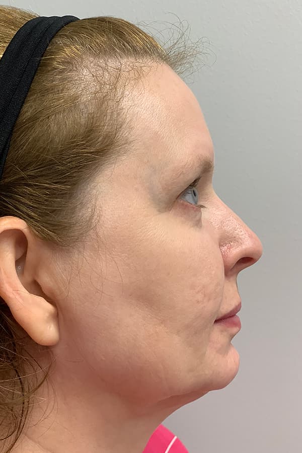 Contour TRL After - Patient 93894534 - Right View
