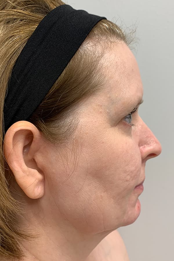Contour TRL Before - Patient 93894534 - Right View