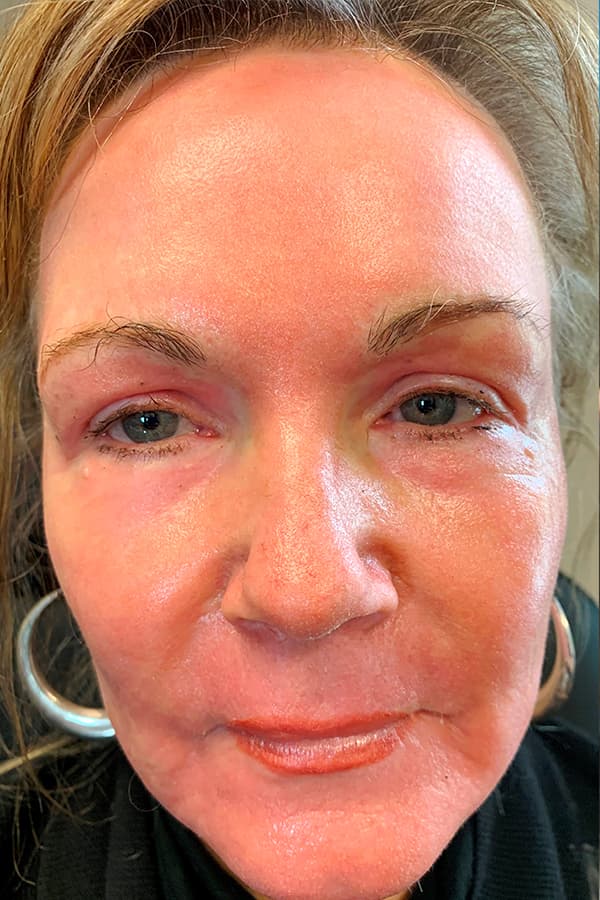 Contour TRL After - Patient 93894543 - Front View