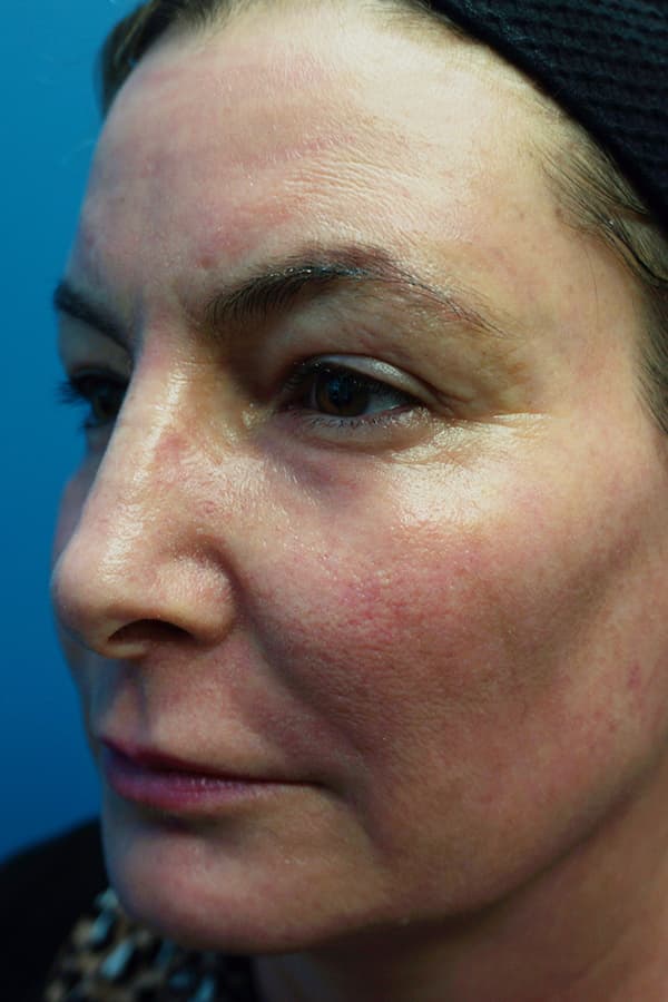 Contour TRL Before - Patient 93894559 - Front View