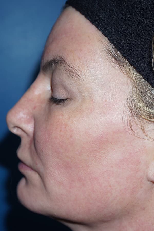 Contour TRL After - Patient 93894559 - Left View