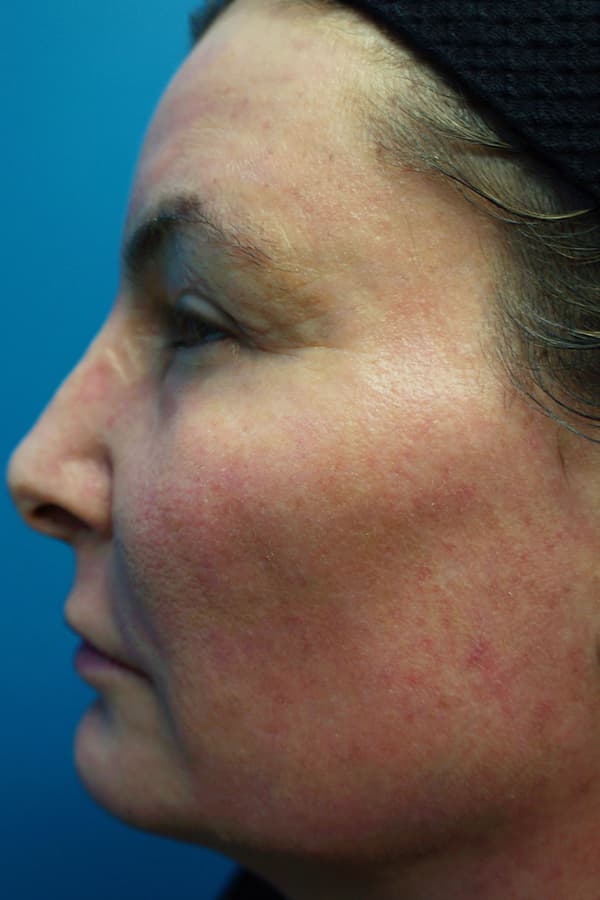Contour TRL Before - Patient 93894559 - Left View