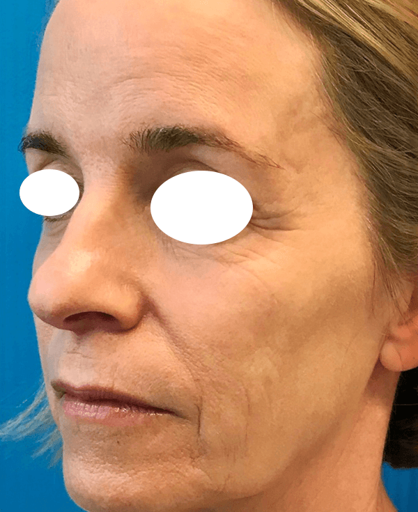 Halo Laser After - Patient 93894414 - Front View