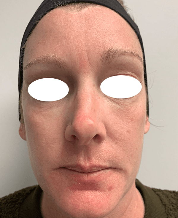 Halo Laser After - Patient 93894439