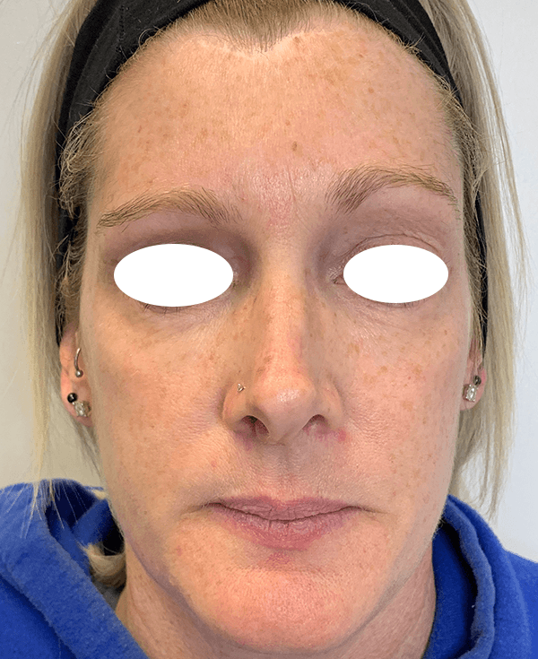 Halo Laser Before - Patient 93894439 - Front View