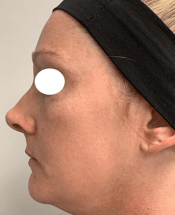 Halo Laser After - Patient 93894439 - Left View