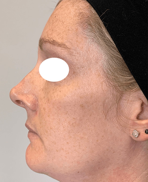 Halo Laser Before - Patient 93894439 - Left View