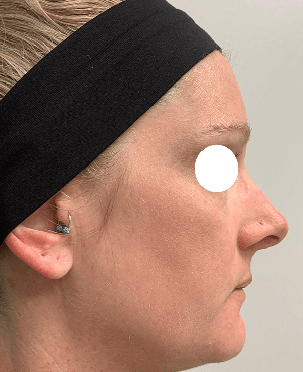 Halo Laser After - Patient 93894439 - Right View