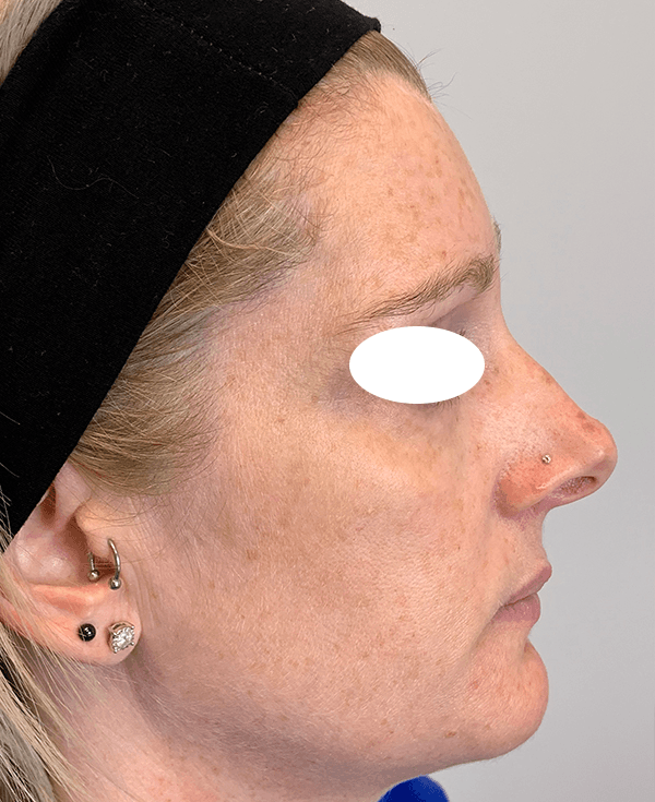 Halo Laser Before - Patient 93894439 - Right View