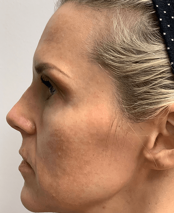 Halo Laser After - Patient 93894458 - Left View