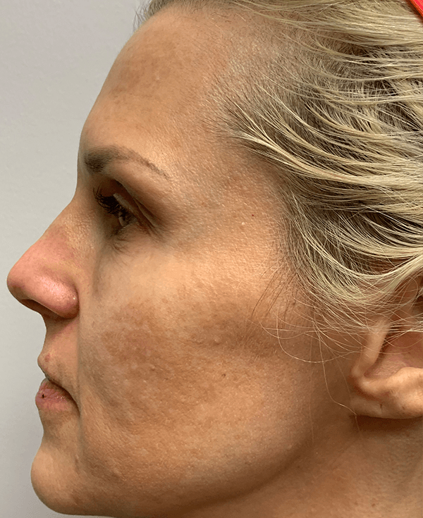 Halo Laser Before - Patient 93894458 - Left View