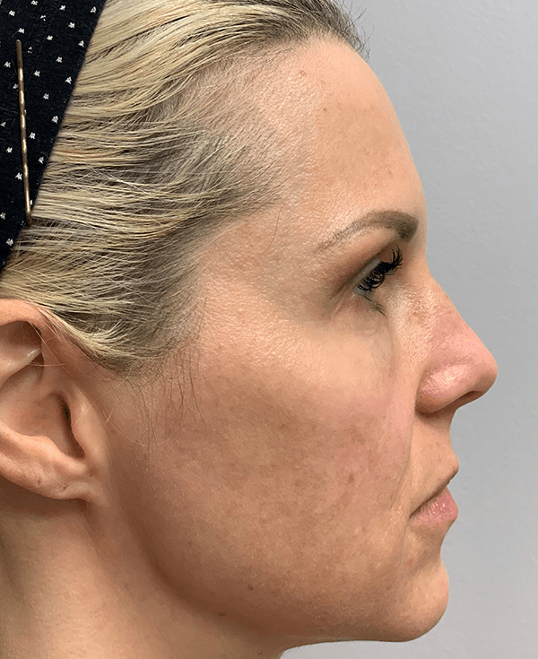 Halo Laser After - Patient 93894458 - Right View