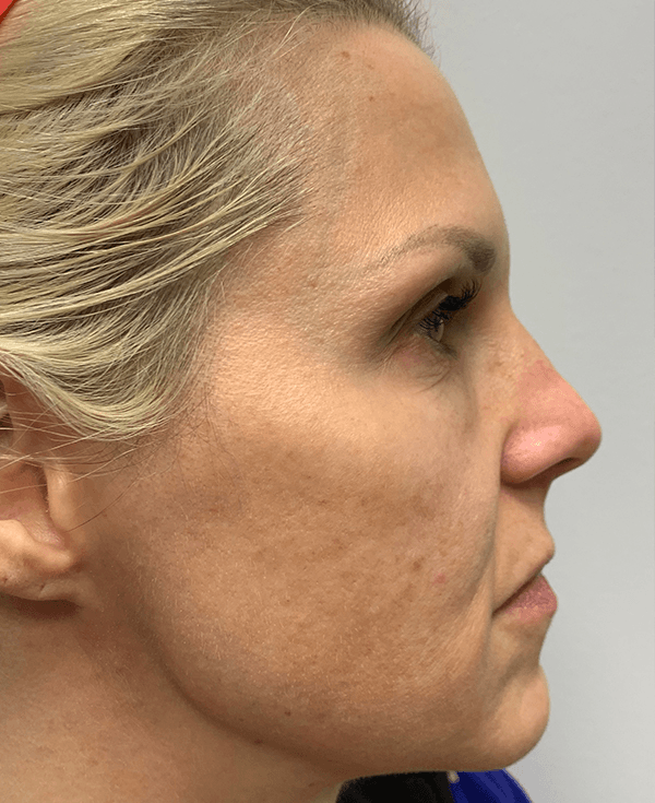 Halo Laser Before - Patient 93894458
