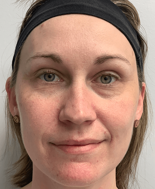 Halo Laser After - Patient 93894513 - Front View