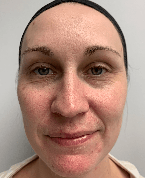 Halo Laser Before - Patient 93894513 - Front View